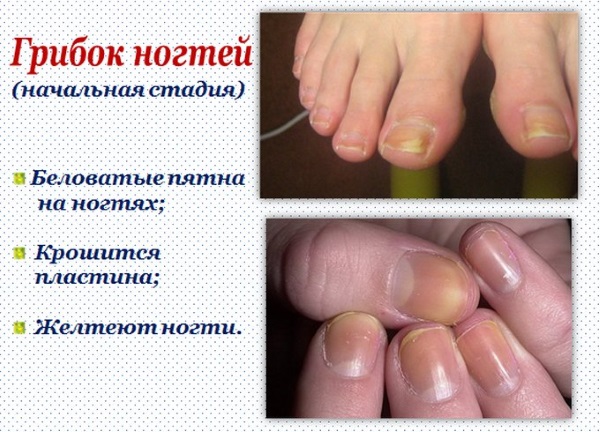 Лечение ногтей на руках и ногах после гель лака, наращивания. Народные рецепты, аптечные средства, система IBX