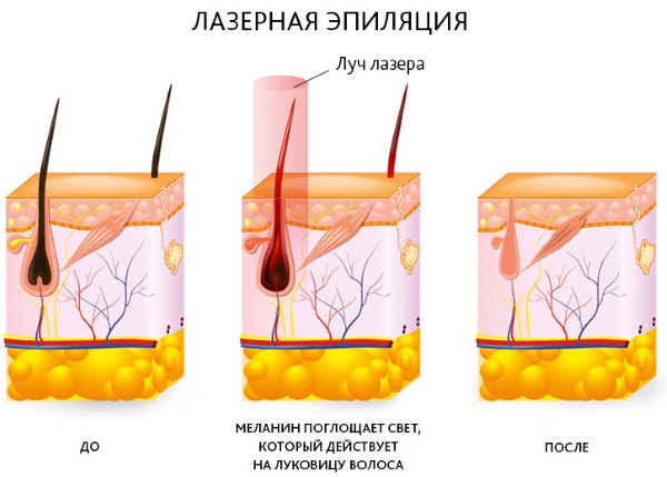 Лазерная эпиляция верхней губы (усиков) у женщин. Сколько сеансов нужно, как делается